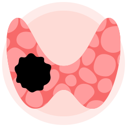 tiroid-kanseri-icon-1